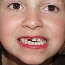 220px-Deciduous_teeth_by_David_Shankbone.webp