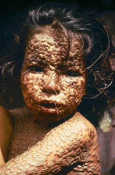 393px-Child_with_Smallpox_Bangladesh.webp