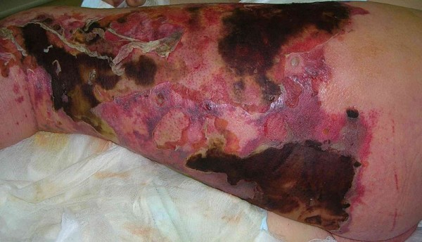 800px-Necrotizing_fasciitis_left_leg-e133959220424.jpg