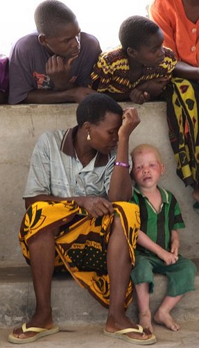 Albino_boy_tanzania.jpg