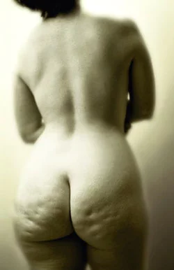 Cellulite.webp