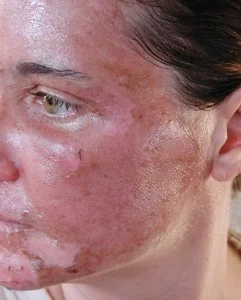 Chemical-Peels-and-Acne-640x795-241x300.webp