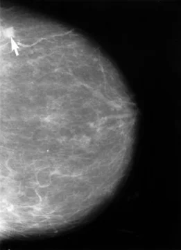 Mammogram_showing_breast_cancer.webp