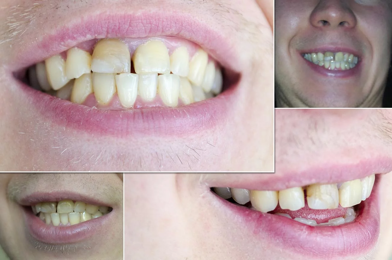 moi-zuby-do-ustanovki-koronok.webp