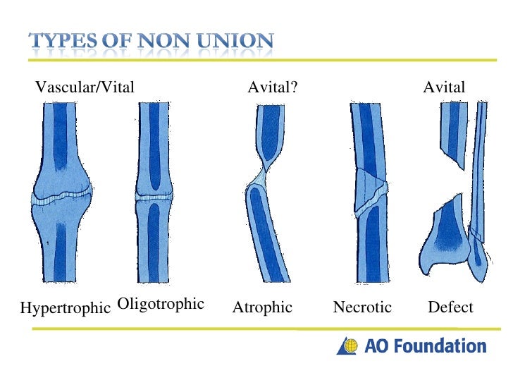 non-union-16-728.jpg