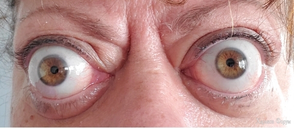 ronic-thyroid-eye-disease-proptosis-before-TEPEZZA.jpg