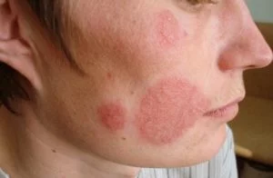 tinea-faciei-pictures-7-300x196.webp