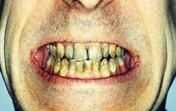 zuby-kurilshika.webp