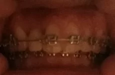 tooth_straight.webp tooth_straight.webp