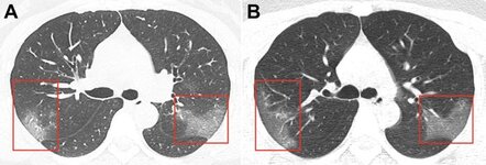 ct scan.jpg