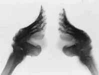 250px-Bound_feet_(X-ray).webp