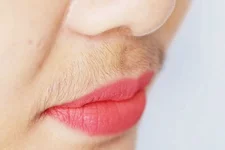 upper-lip-header-1024x683.webp