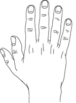 Polydactyly_preaxial.gif