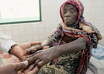 leprosy-treatment-3.jpg