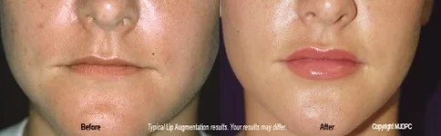lip_augmentation3.jpg
