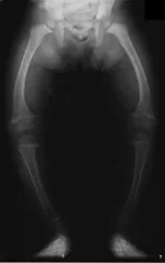190px-XrayRicketsLegssmall[1].webp