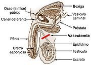 180px-Vasectomia.jpg